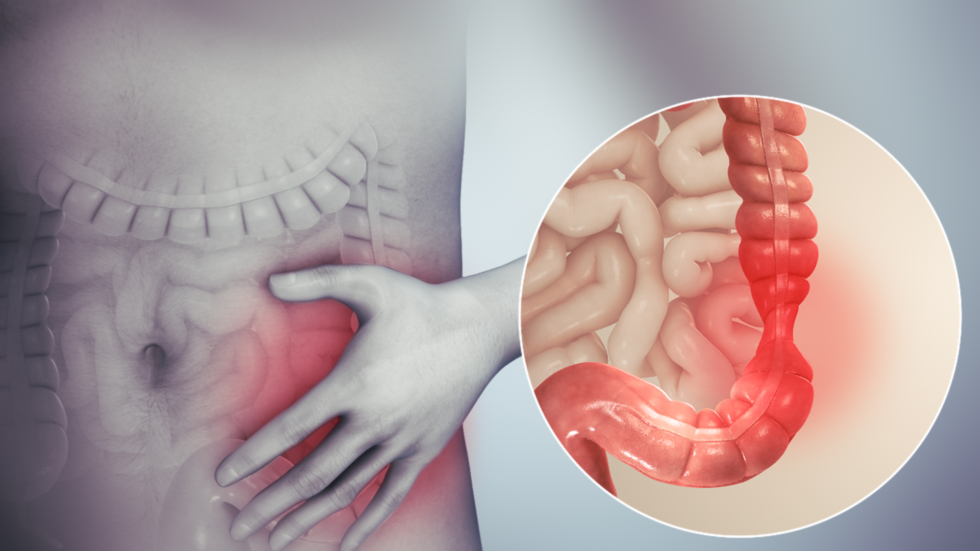 Irritable_bowel_syndrome Managing IBS & Bowel Conditions